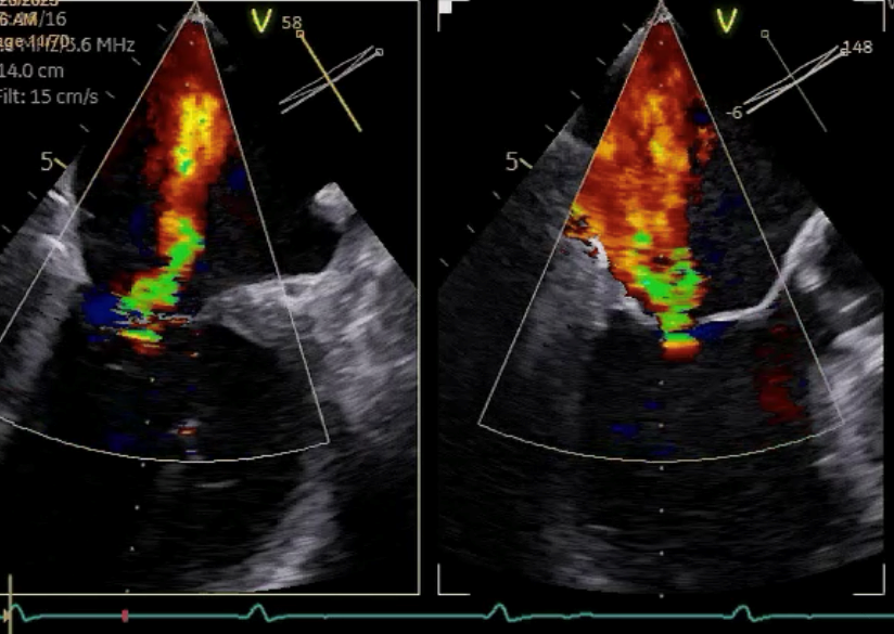 EKG Bild zwei zwei unterschiedlich weit voneinander befindliche helle Schatten
